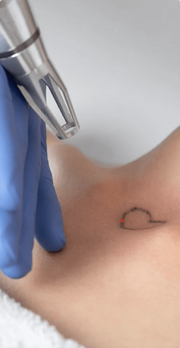 Tattoo removal machine